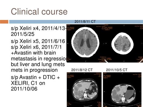 Colon cancer with brain metastasis