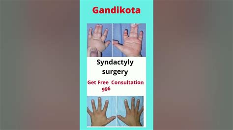 Syndactyly surgery cost in Gundikota | Syndactyly treatment in Gundikota - YouTube