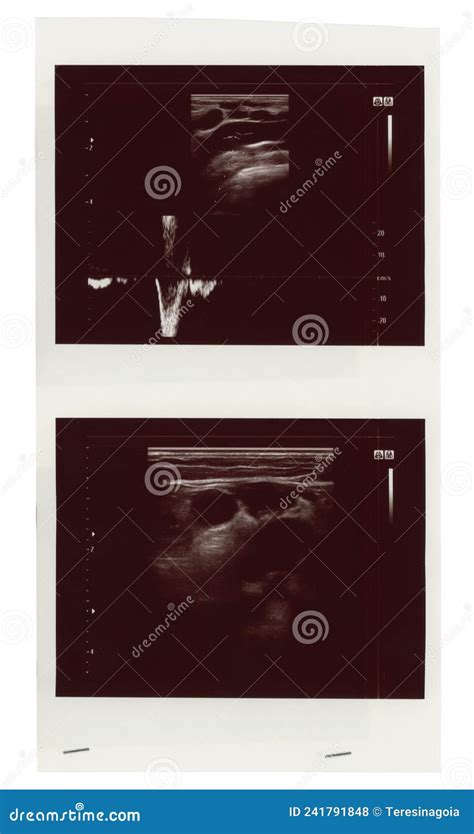 Diagnostic Sonography Of Abdomen Royalty-Free Stock Image ...