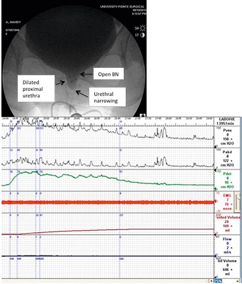 Urodynamics: Indications, techniques, interpretation, and clinical utility | Obgyn Key