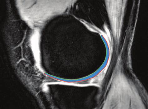 Sagittal slice of an MR scan of the knee joint. The cartilage is marked ...