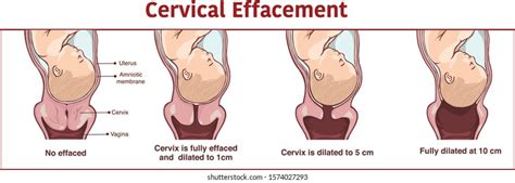 Vector Cervical Effacement Dilatation During Labor: vetor stock (livre ...