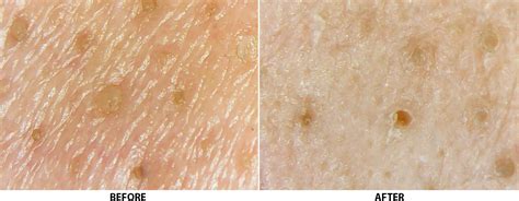 These Microscopic Pore Images Prove that Blackhead-Removing Peel-Off ...