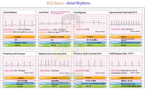 Printable Ekg Rhythms