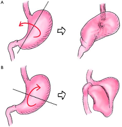 Paraesophageal Hernia With Gastric Volvulus