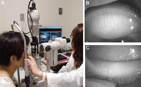 noninvasive meibography. Notes: Photographs demonstrate the (A)... | Download Scientific Diagram