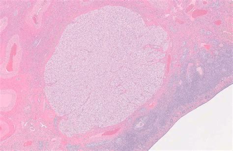 Corpus Albicans Histology