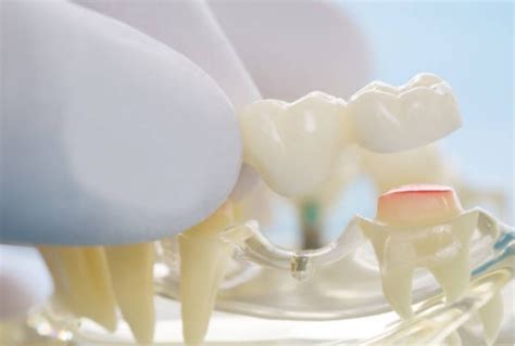 Why Need a Teeth Bridge: Insights and Causes Explained