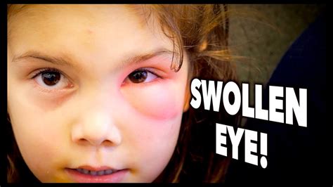 SWOLLEN EYE! (Periorbital Cellulitis?) | Dr. Paul - YouTube