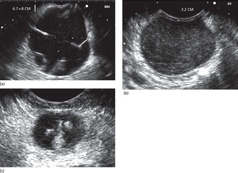 Pancreatic Cystic Lesions | Radiology Key