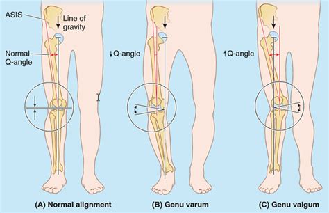 Patellar dislocation causes, symptoms, diagnosis, treatment & prognosis