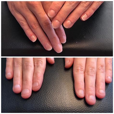 My nails before and after gelnails. : r/nailbiting