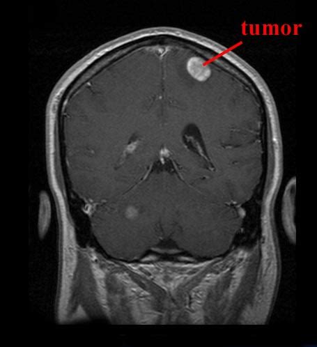 Tumor: Brain Tumor Mri