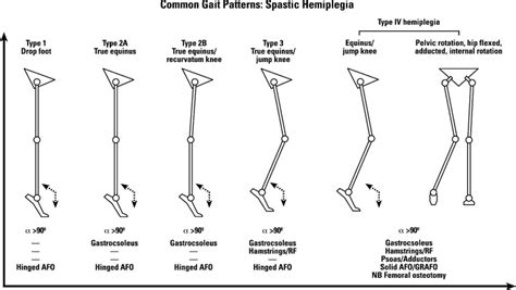 Figure 1: Classification of gait patterns in spastic hemiplegia ...