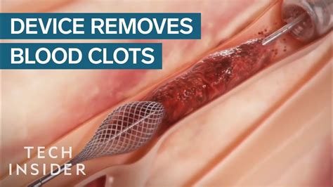 How This Device Safely Removes Blood Clots | Tech Insider - YouTube