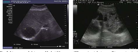 Figure 2 from Ultrasound Imaging of Liver Tumors – Current Clinical ...