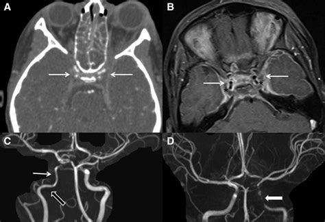 Cavernous Sinus Thrombosis in Children | Stroke