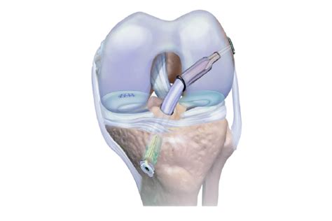 ACL & PCL ligament Reconstruction Surgery | Anup Institute Of ...