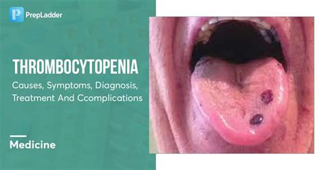 Thrombocytopenia: Causes, Symptoms, Diagnosis, Treatment and Complications