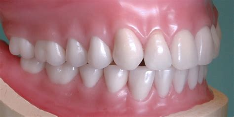 COMPLETE DENTURES | Foundation for Oral-facial Rehabilitation