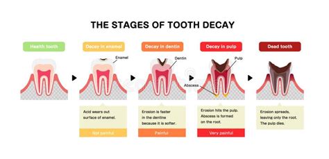 The Stages of Tooth Decay / Flat Vector Illustration Stock Vector ...