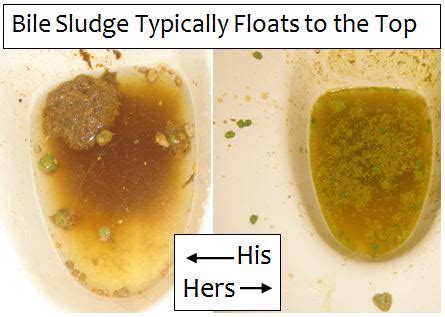 Bile Sludge Pictures - Debug Your Health