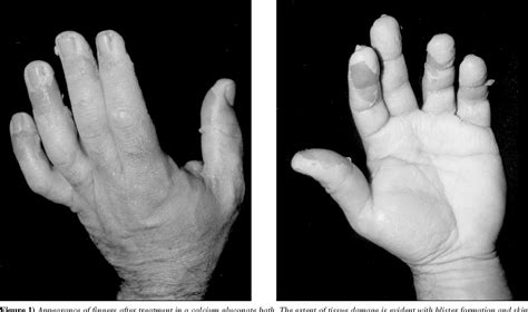 Figure 1 from Hydrofluoric Acid Burns: A Case Report | Semantic Scholar