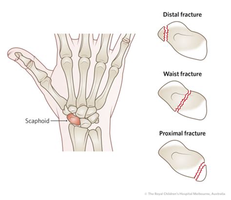 Scaphoid Fracture - Motus Physical Therapy