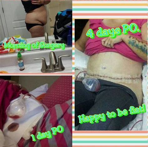 Gallery of tummy tuck before and after photos » Tummy Tuck: Prices ...