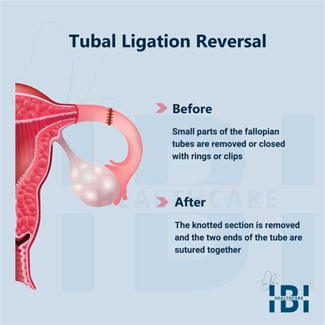 Weight Loss After Tubal Ligation Reversal | Blog Dandk