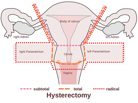 Important Facts About Hysterectomy | Urology Specialist