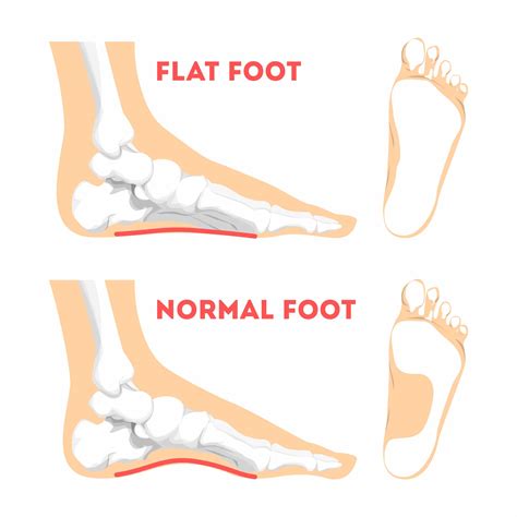 Flat Feet: Symptoms, Causes and Stages | Seaview Orthopaedics