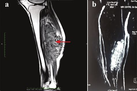 Arteriovenous Malformation Mri