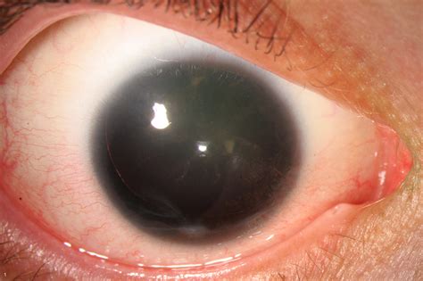 Aniridia RE anterior segment | UK EGG - The UK Eye Genetics Group