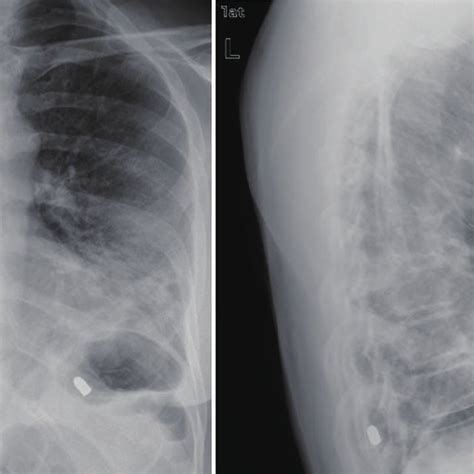 Admission chest X-ray showing bilateral patchy infiltrates. | Download Scientific Diagram