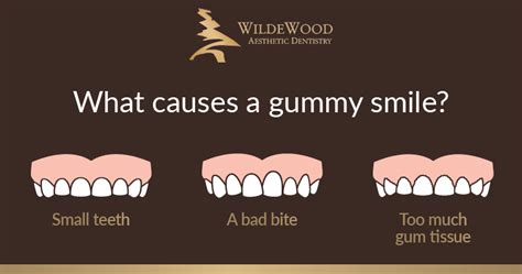 How To Fix a Gummy Smile (It's Easier Than You Think!)