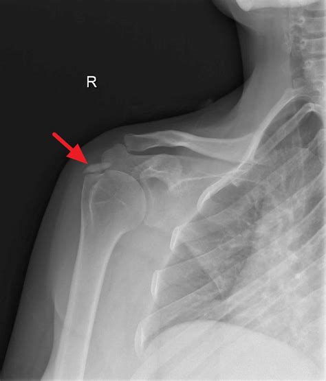 Calcific tendinosis causes, symptoms, diagnosis, treatment & prognosis