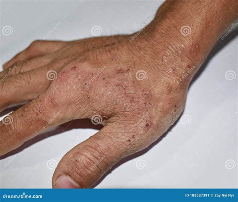 Tinea Manus or Fungal Infection on Hand of Southeast Asian, Burmese Adult Man. Stock Image ...