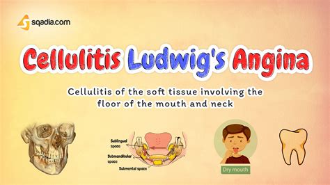 Incision For Ludwigs Angina