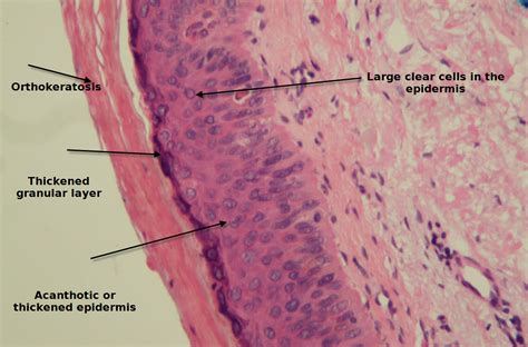 Pathology Outlines - Large cell acanthoma