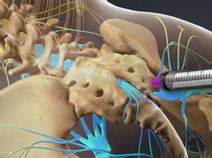 Caudal Epidural Steroid Injection | Premier Pain Centers in NJ