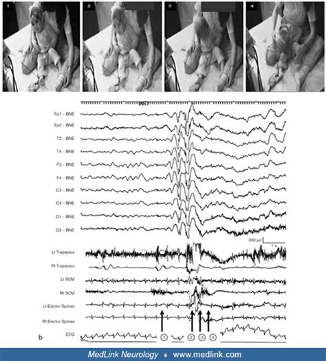 Myoclonic-atonic seizures | MedLink Neurology