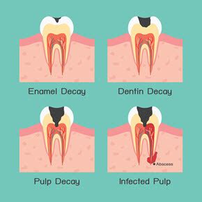 Why Are Dental Crowns Recommended After A Root Canal - Endodontics