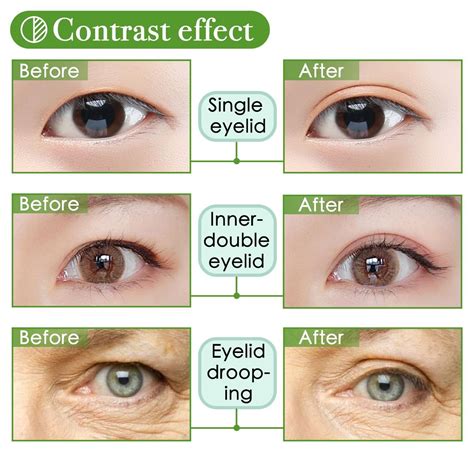 Single Eyelid Vs Double Eyelid