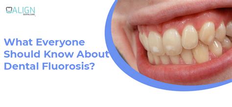 What everyone should know about dental fluorosis?