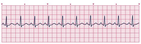 UNC MEDIA | Heart Rhythms