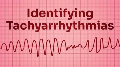 Identifying Tachyarrhythmias | Ausmed Lectures