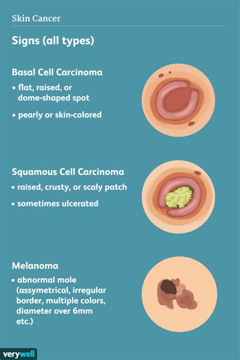 Skin Cancer: Signs, Symptoms, and Complications