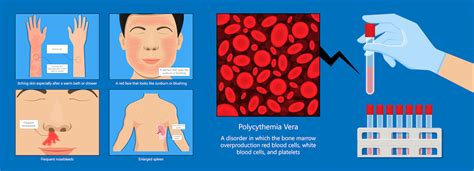 Polycythemia Vera: Cause, Stages, Symptoms & Treatments - Page 2 of 2