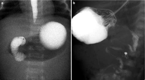 Fig. 15.3, [Intestinal malrotation results from incomplete ...